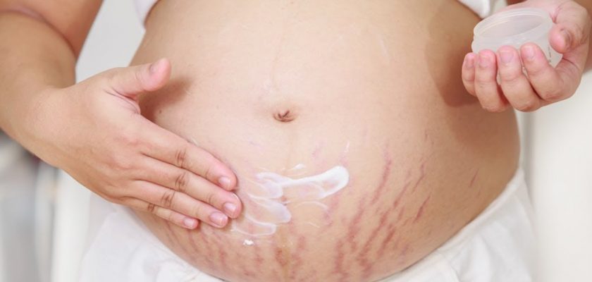 Hamilelikte Çatlak Oluşumu En Aza İndirme Yolları